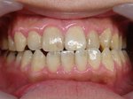 歯の消しゴム、シロティとビーポリッシュ02