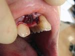 歯牙再植術01