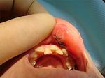 歯牙再植術05