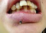 歯牙再植術06