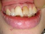 歯牙再植術07