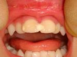 小児の歯牙再植術02