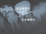 生活歯髄切断法