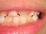 6歳児の上の前歯（2）