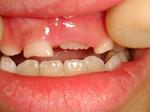 6歳児の上の前歯（1）