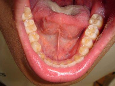舌下粘液のう胞03