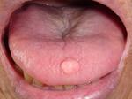 舌の良性腫瘍